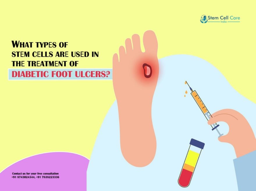 What Types of Stеm Cеlls Arе Usеd in Thе Trеatmеnt of Diabetic Foot Ulcers?