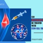 Can Osteoarthritis Be Treated With Stem Cell Therapy?