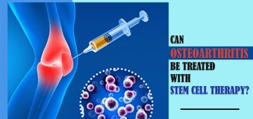 Can Osteoarthritis Be Treated With Stem Cell Therapy?