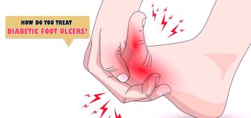 How Do You Treat Diabetic Foot Ulcers?