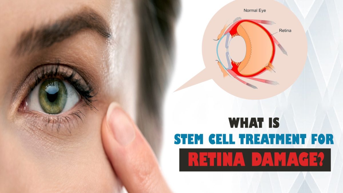 What Is Stem Cell Treatment for Retina Damage?