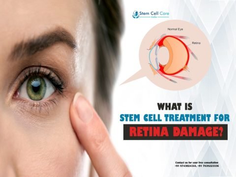 What Is Stem Cell Treatment for Retina Damage?