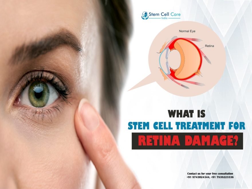 What Is Stem Cell Treatment for Retina Damage?