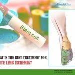 What Is the Best Treatment for Acute Limb Ischemia?