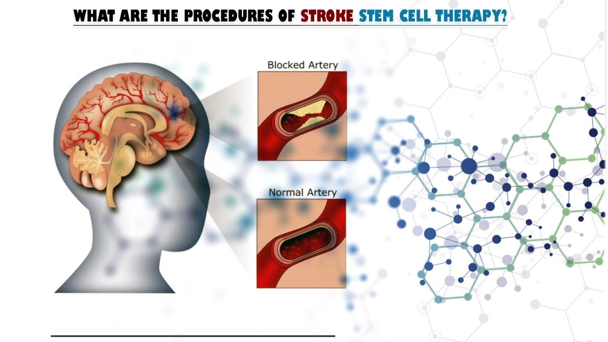 What Are the Procedures of Stroke Stem Cell Therapy?
