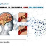 What Are the Procedures of Stroke Stem Cell Therapy?