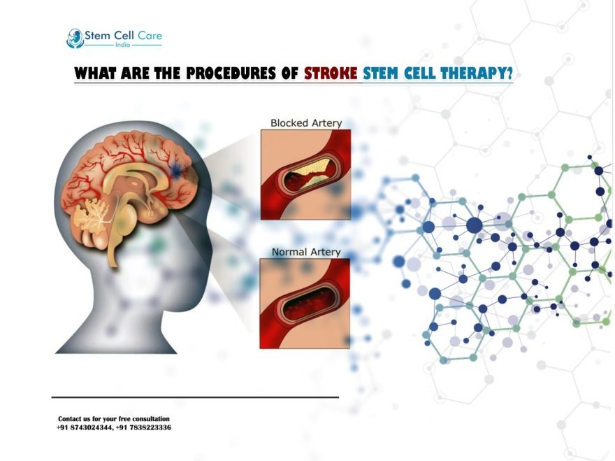 What Are the Procedures of Stroke Stem Cell Therapy?