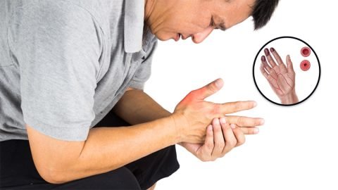 Exosome Treatment For Buerger’s