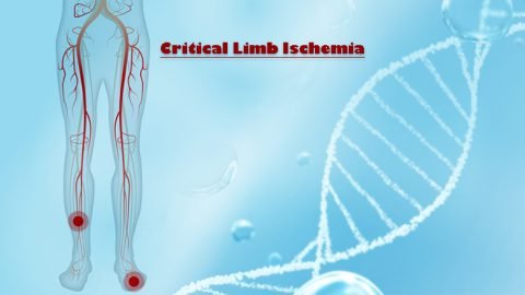 Exosome Treatment For Critical Limb Ischemia