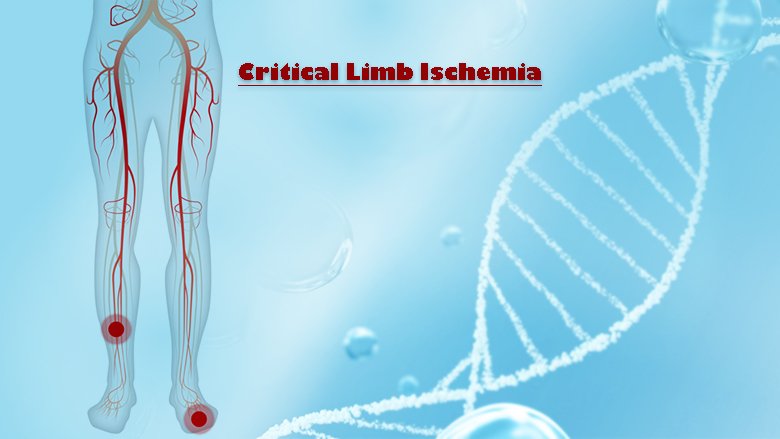 Exosome Treatment For Critical Limb Ischemia