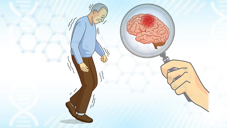 Exosome Treatment for Parkinson’s Disease