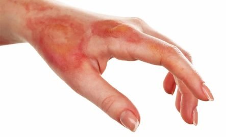 Exosome treatment for Skin Burns