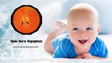 Exosome Treatment For Optic Nerve Hypoplasia