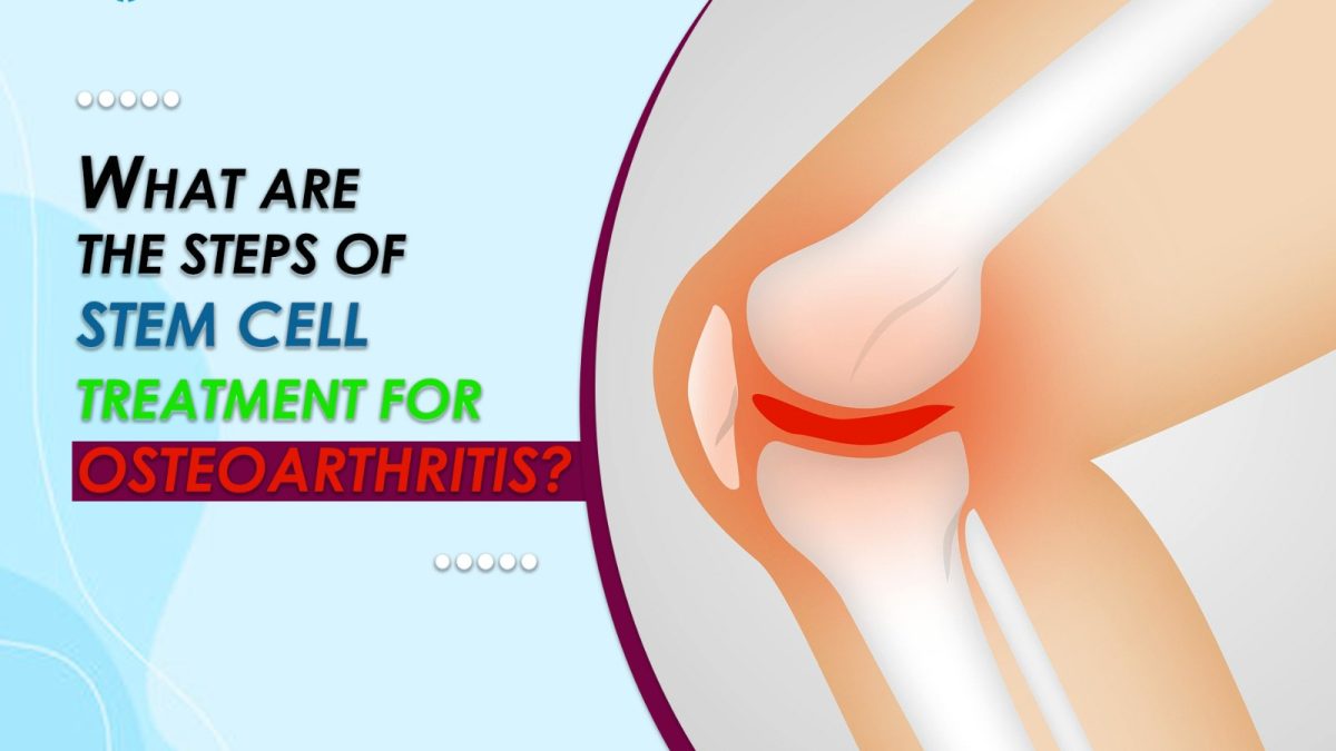 What Are the Steps of Stem Cell Treatment for Osteoarthritis?