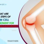 What Are the Steps of Stem Cell Treatment for Osteoarthritis?