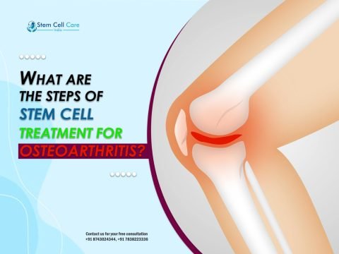 What Are the Steps of Stem Cell Treatment for Osteoarthritis?