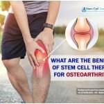 What Are the Benefits of Stem Cell Therapy for Osteoarthritis?