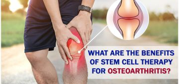 What Are the Benefits of Stem Cell Therapy for Osteoarthritis?