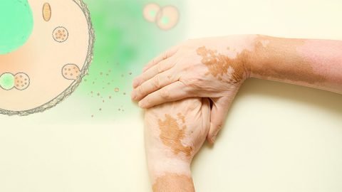 Exosome Treatment For Vitiligo