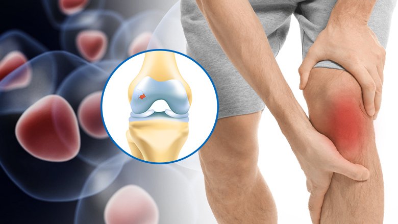 Stem Cell Treatment for Cartilage Repair