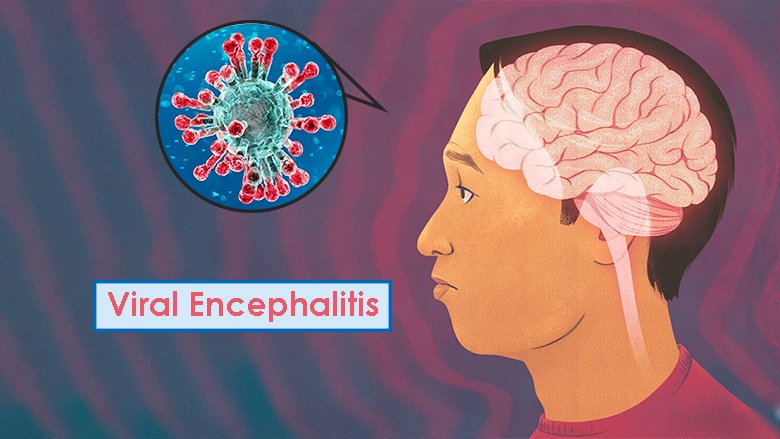 Stem Cell Treatment for Viral Encephalitis