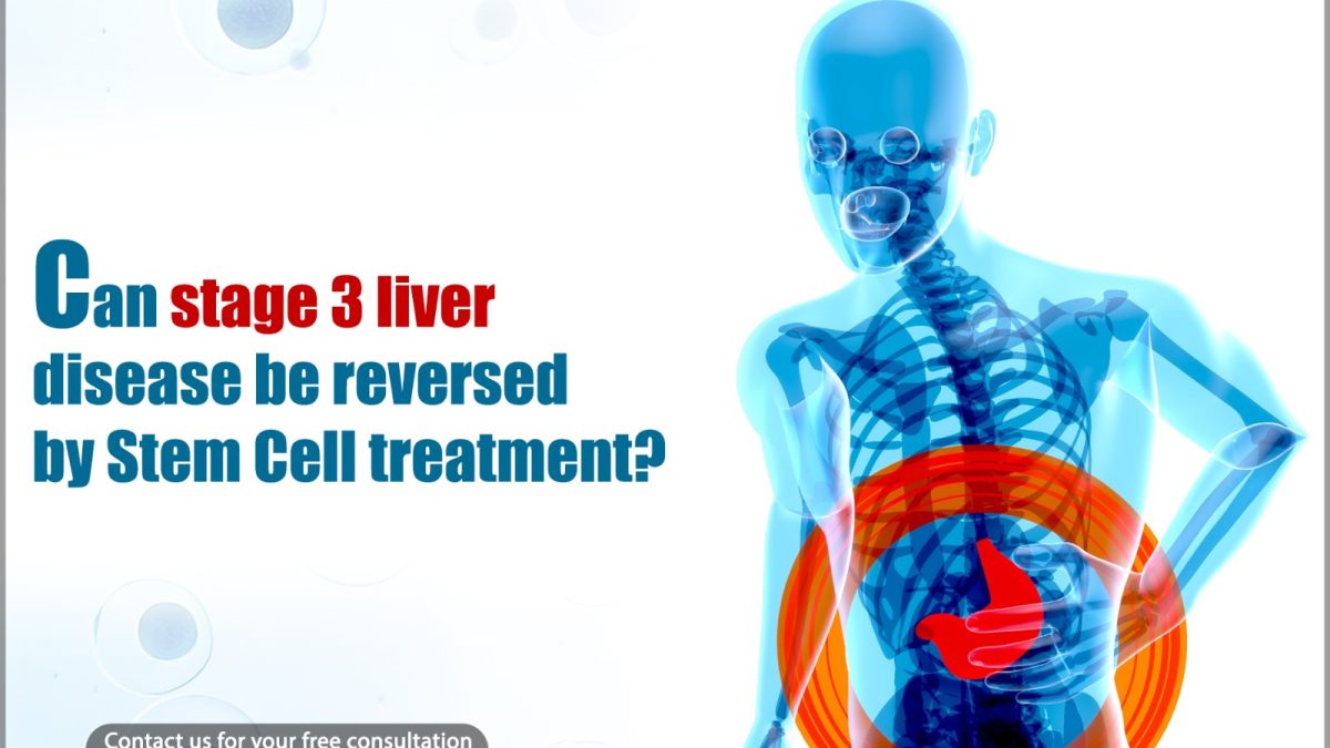 Stage 3 Liver Disease