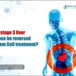 Stage 3 Liver Disease