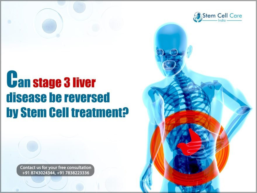 Stage 3 Liver Disease