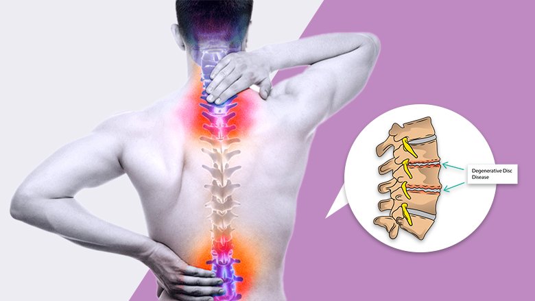 Degenerative Disc Degenerative Disc