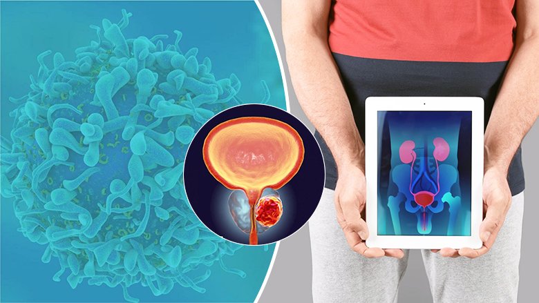 Immunotherapy for Prostate Cancer in India Immunotherapy for Prostate Cancer in India