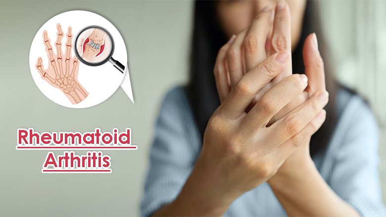 Rheumatoid Arthritis