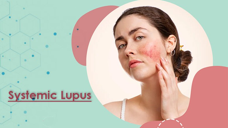 Systemic lupus