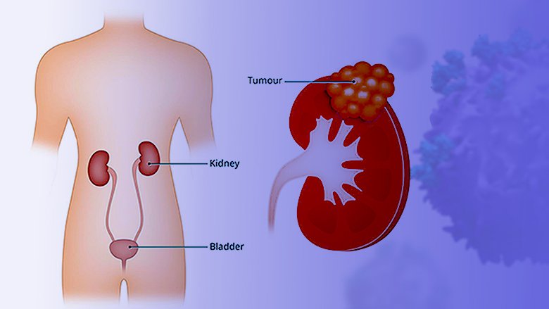 mmunotherapy for Kidney Cancer in India