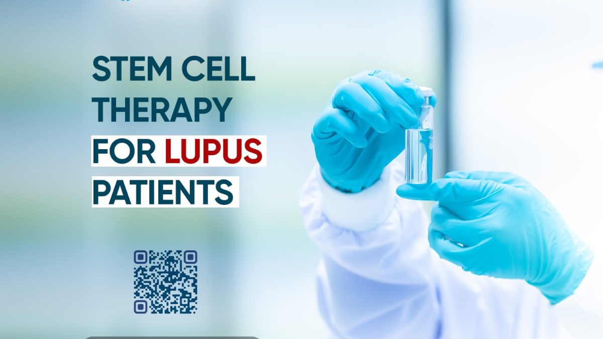 Stem Cell Therapy for Lupus Patients