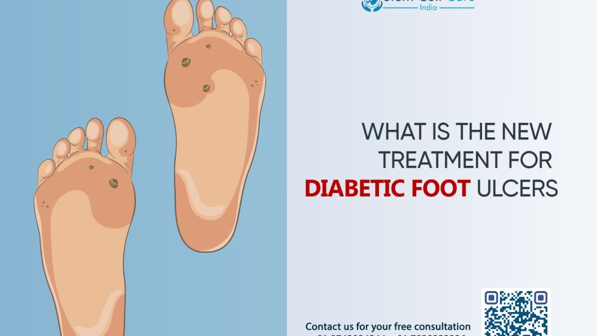 What Is the New Treatment for Diabetic Foot Ulcers?