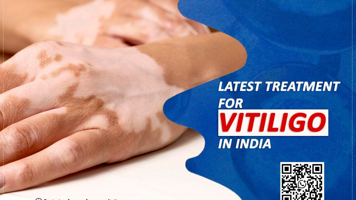 Latest Treatment for Vitiligo in India