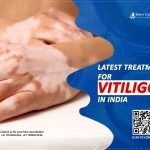 Latest Treatment for Vitiligo in India