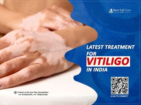 Latest Treatment for Vitiligo in India