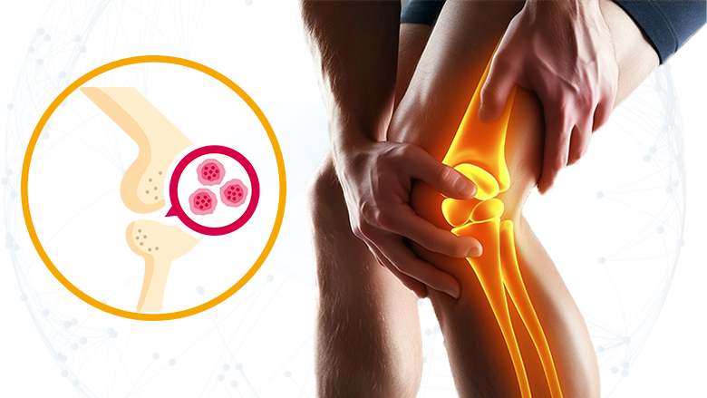 Stem Cell Treatment for Cartilage Repair