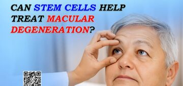 Can Stem Cells Help Treat Macular Degeneration?